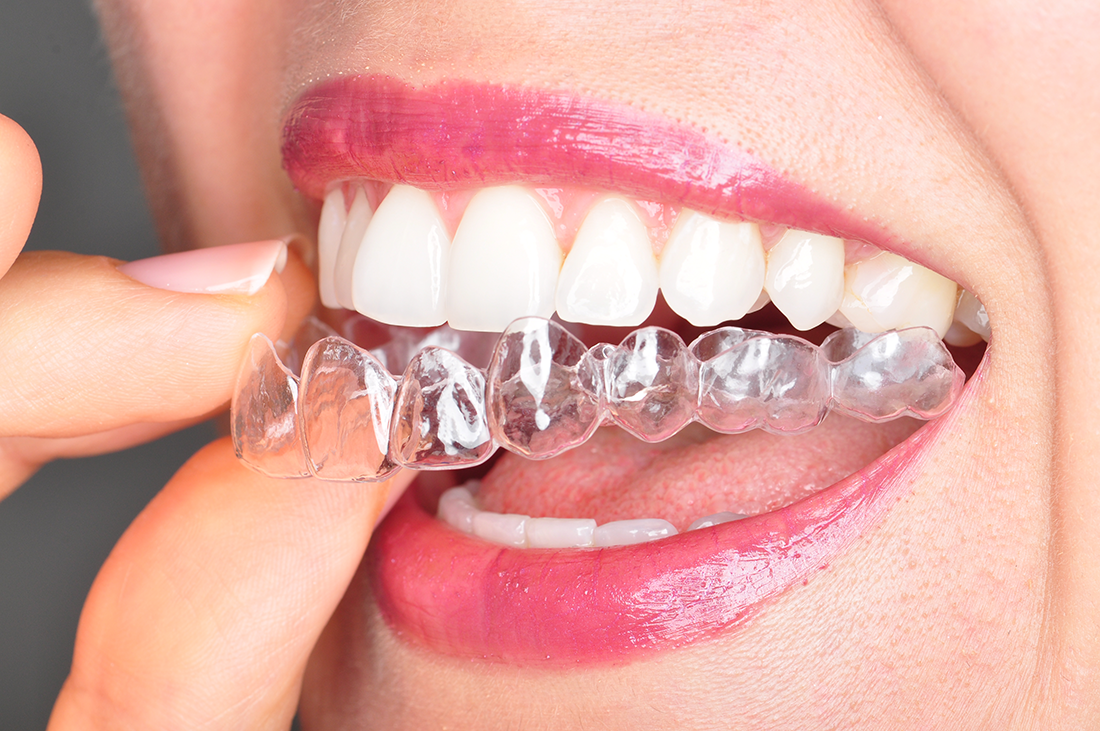 wybielanie zębów - zdrowy uśmiech jako efekt wybielania nakładkowego