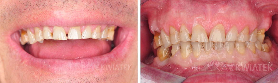 zastosowanie koron protetycznych u pacjenta - zdjęcie przed i po zabiegu - Klinika Kwiatek Poznań