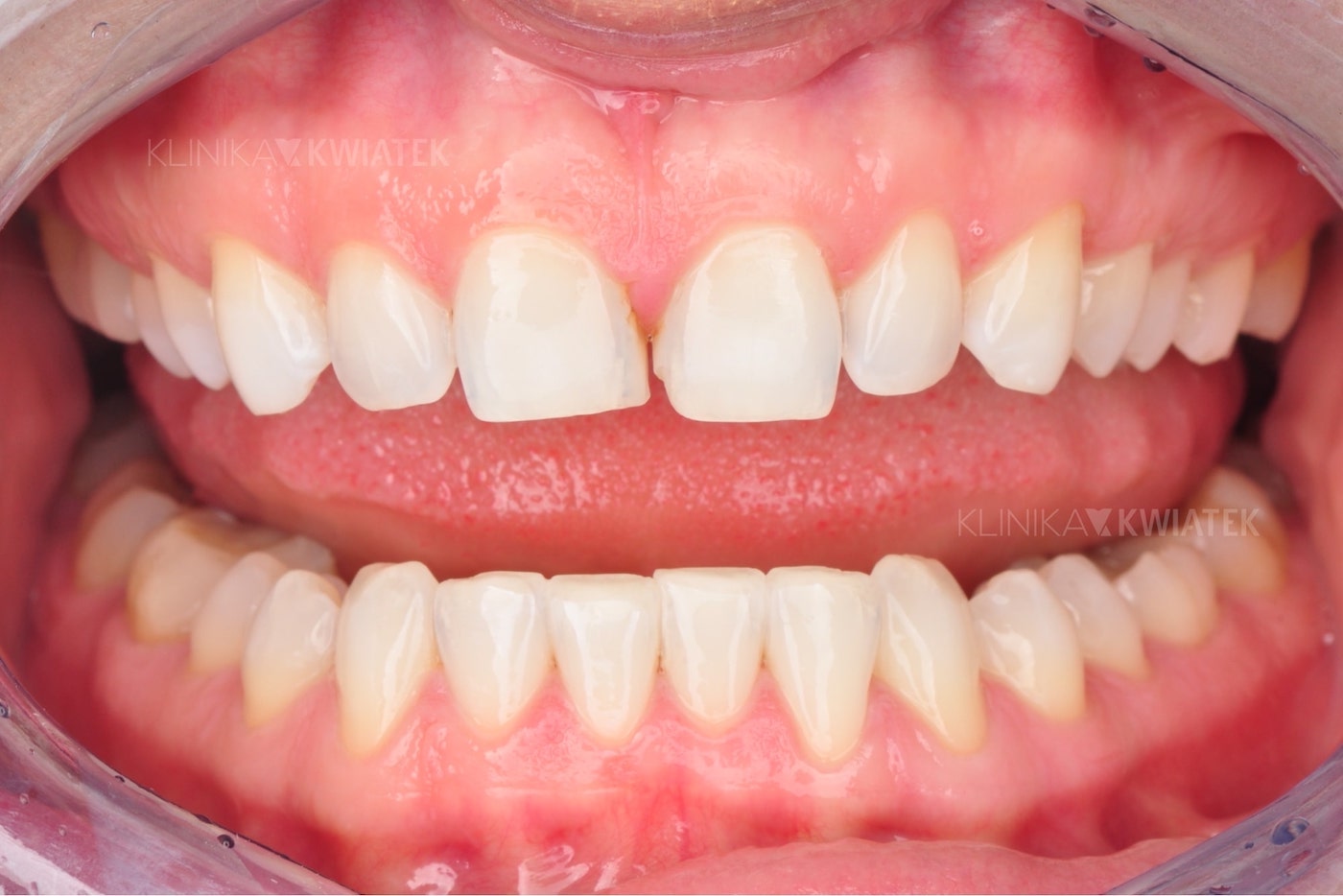 Licówki umożliwiają korektę nierównych zębów