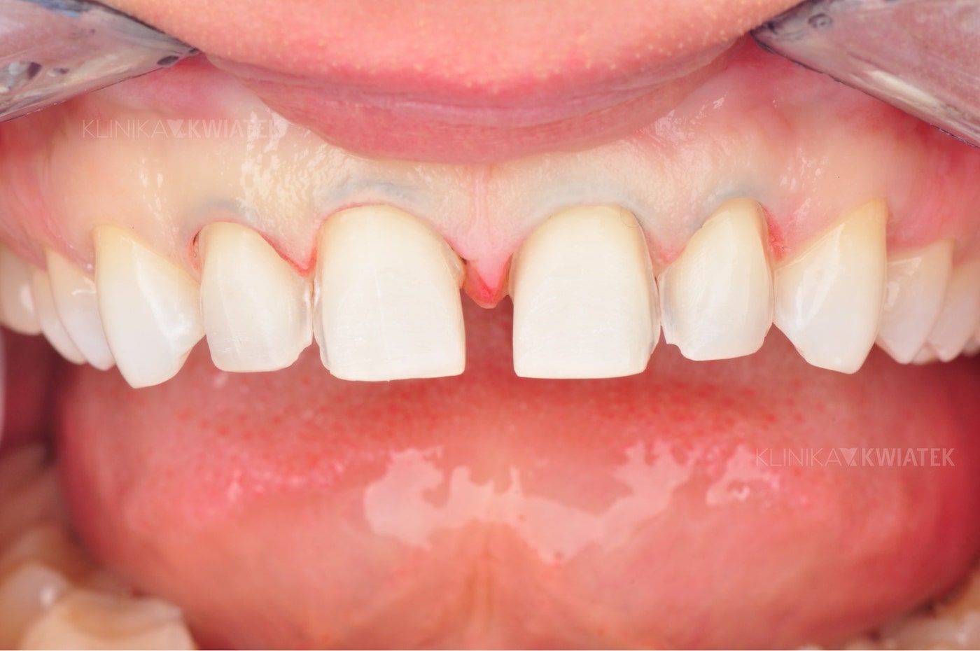 Zęby oszlifowane przed zabiegiem