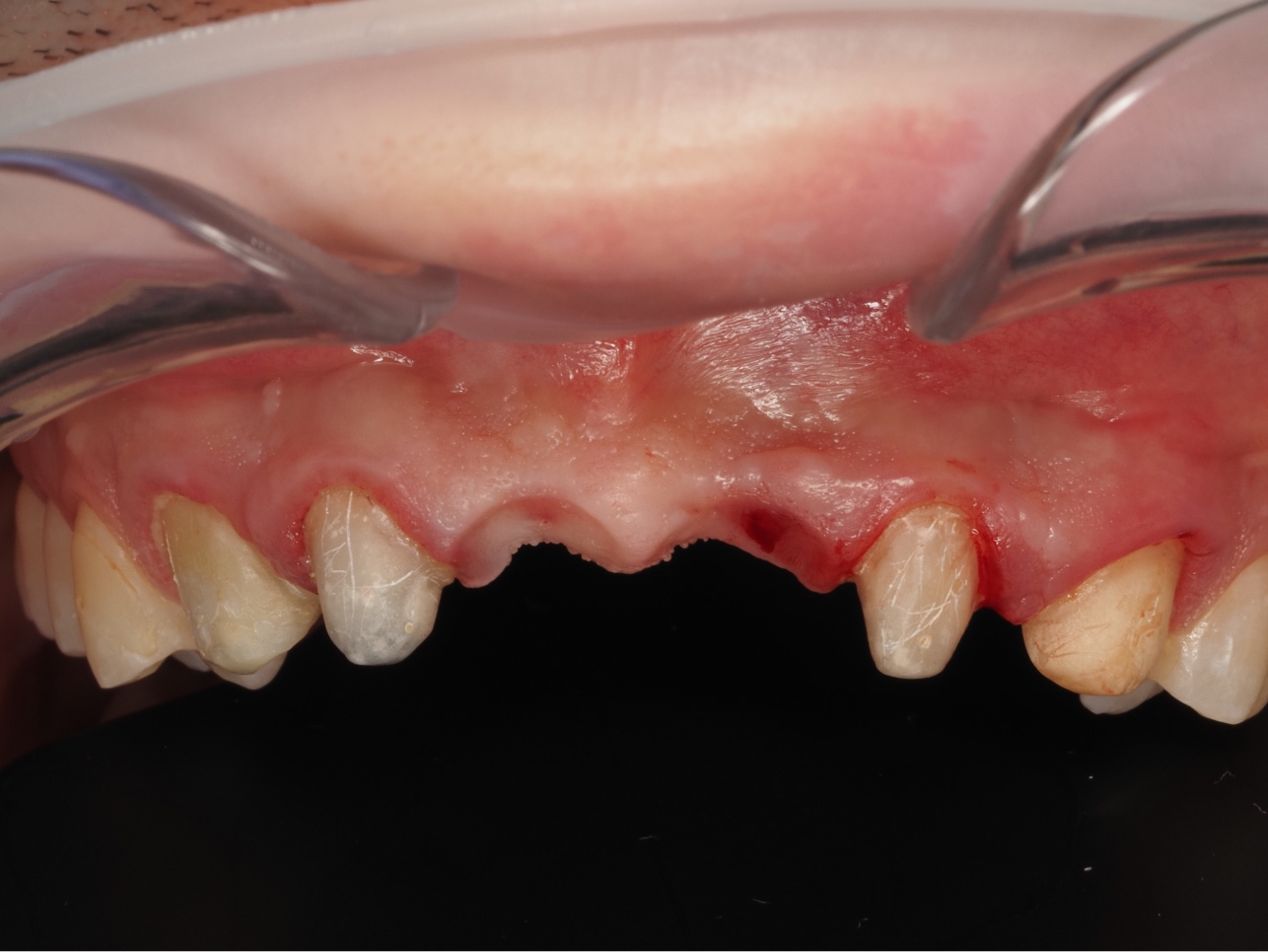 wszczepienie dwóch implantów, cena pojedynczego implantu
