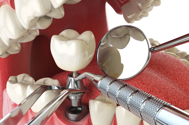 ile po wyrwaniu zęba można założyć implant