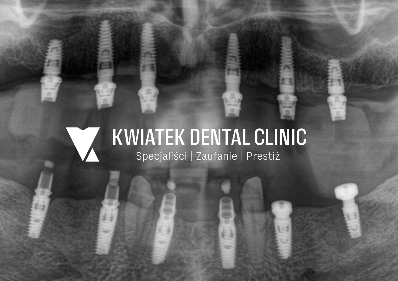 typowe implanty zębowe, standardowe implanty, innowacyjne metody leczenia, choroby przyzębia