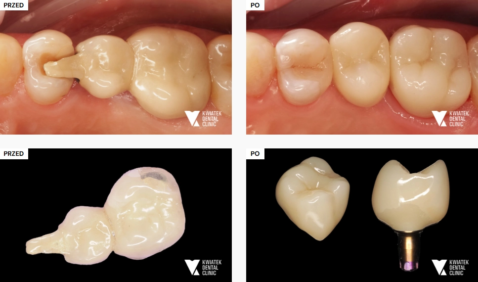 regeneracja kości po wygojeniu implantu, implanty wykonane w klinice kwiatek