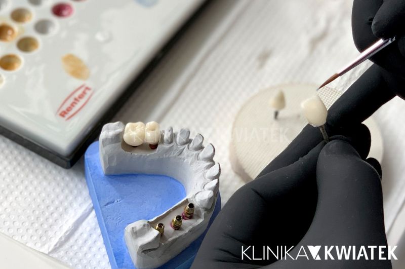 korony ceramiczne tworzące estetyczne implanty zębów