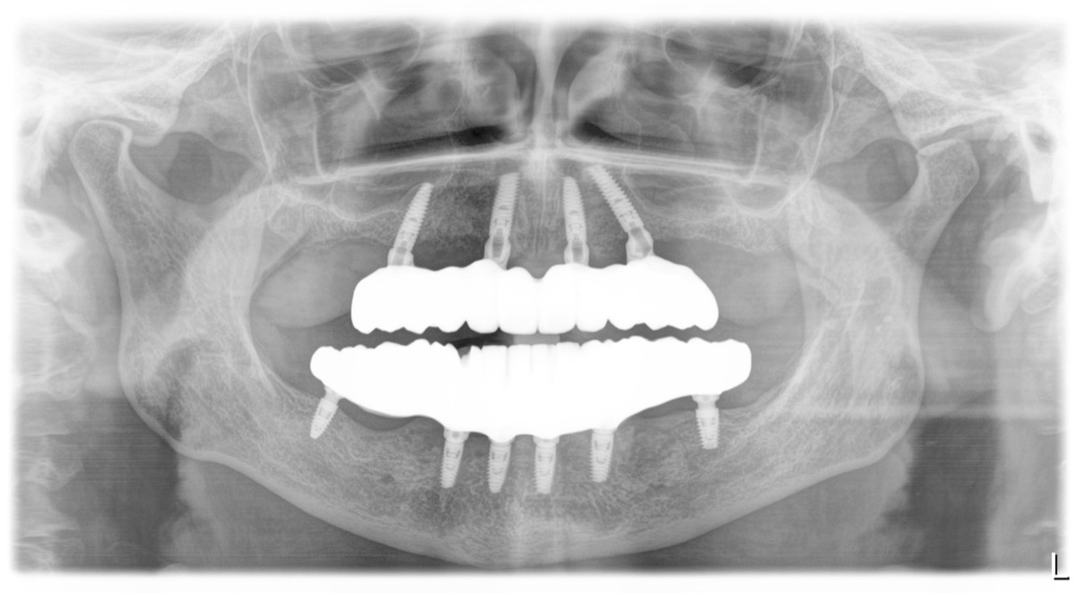 Odbudowa zębów w szczęce na czterech implantach
