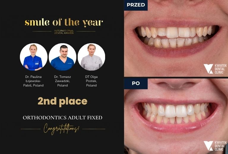 Międzynarodowy Konkurs Smile of The Year 2026 by Dental Tribune II miejsce
