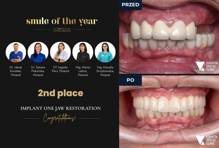 Międzynarodowy Konkurs Smile of The Year 2026 by Dental Tribune II miejsce